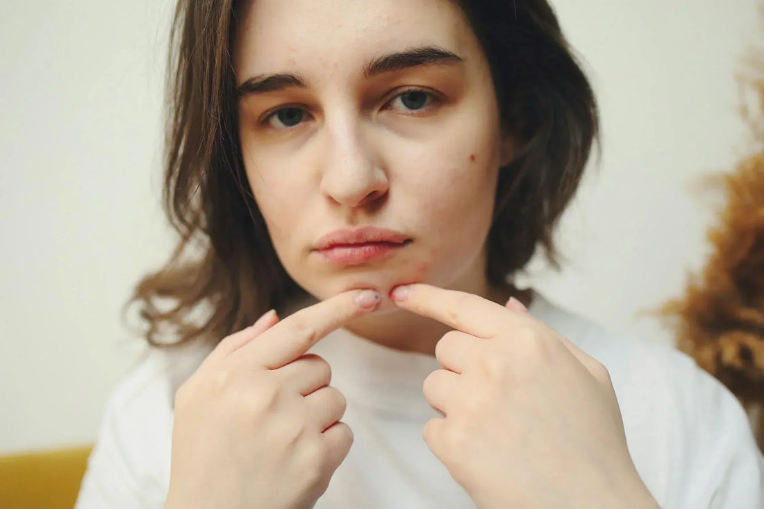 Does Creatine Cause Acne? Investigating the Potential Link