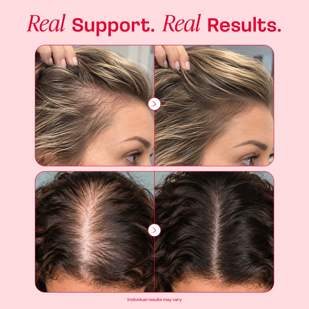 Antes y después: raya y línea del cabello con más volumen. Los resultados individuales pueden variar.